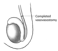 California Vasectomy and Vasectomy Reversal Center