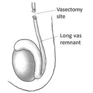 What Is the Vasectomy Reversal Recovery Time? - Top Vasectomy Reversal  Doctor NYC